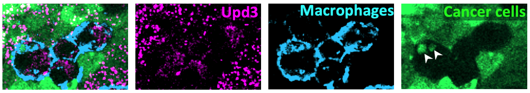 Macrophages consuming dying cancer cells and releasing inflammatory cytokines Hirooka et al., 2025 N Agoya University.png