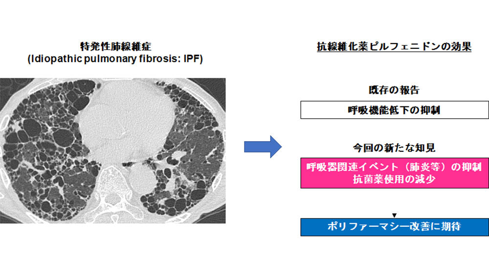 嚢胞性線維症の人が胸部治療を必要とするのはどのような場合ですか?
