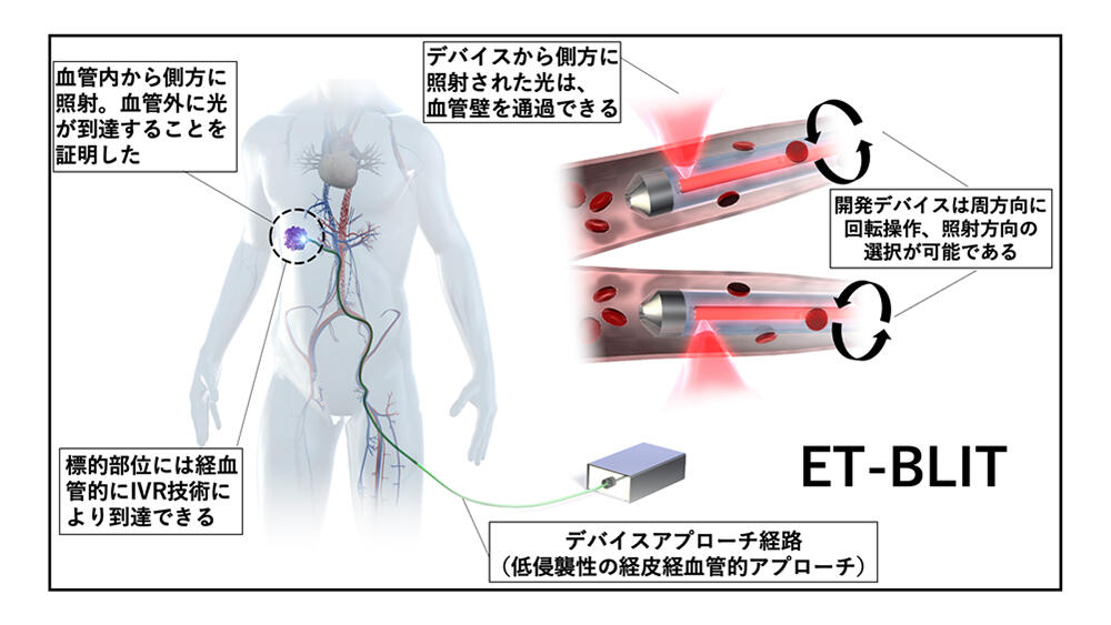 体を隅々まで照らす新規生体光デバイス・システムを開発！：血管内治療
