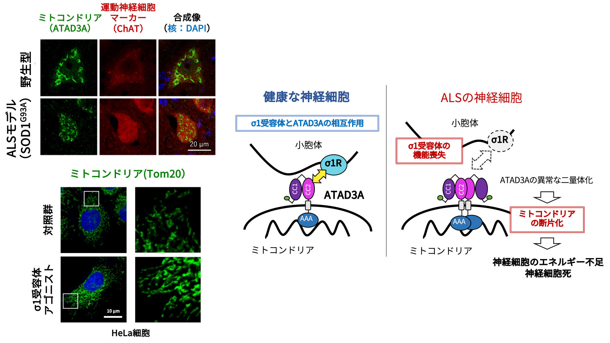 PLSとALSの原因は何ですか?