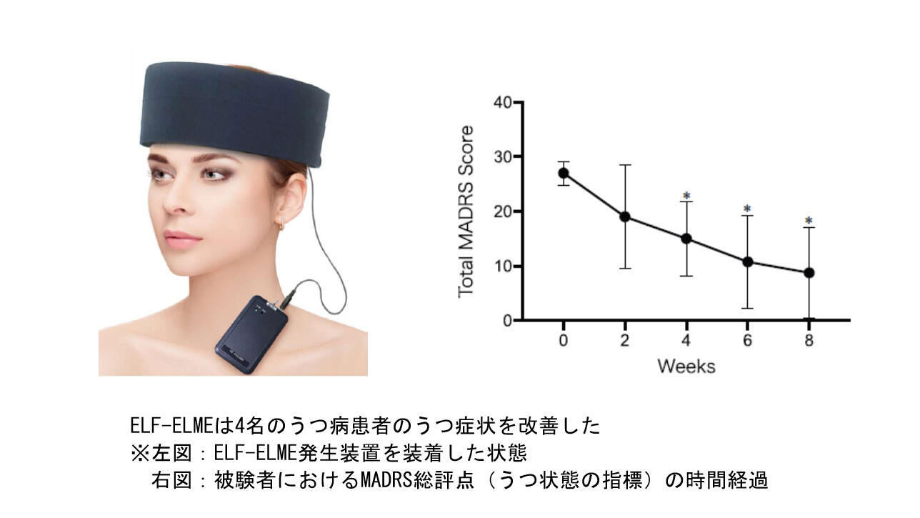 新作 うつ病に対する超低周波変動・超微弱磁場環境（ELF-ELME）治療 精神医学