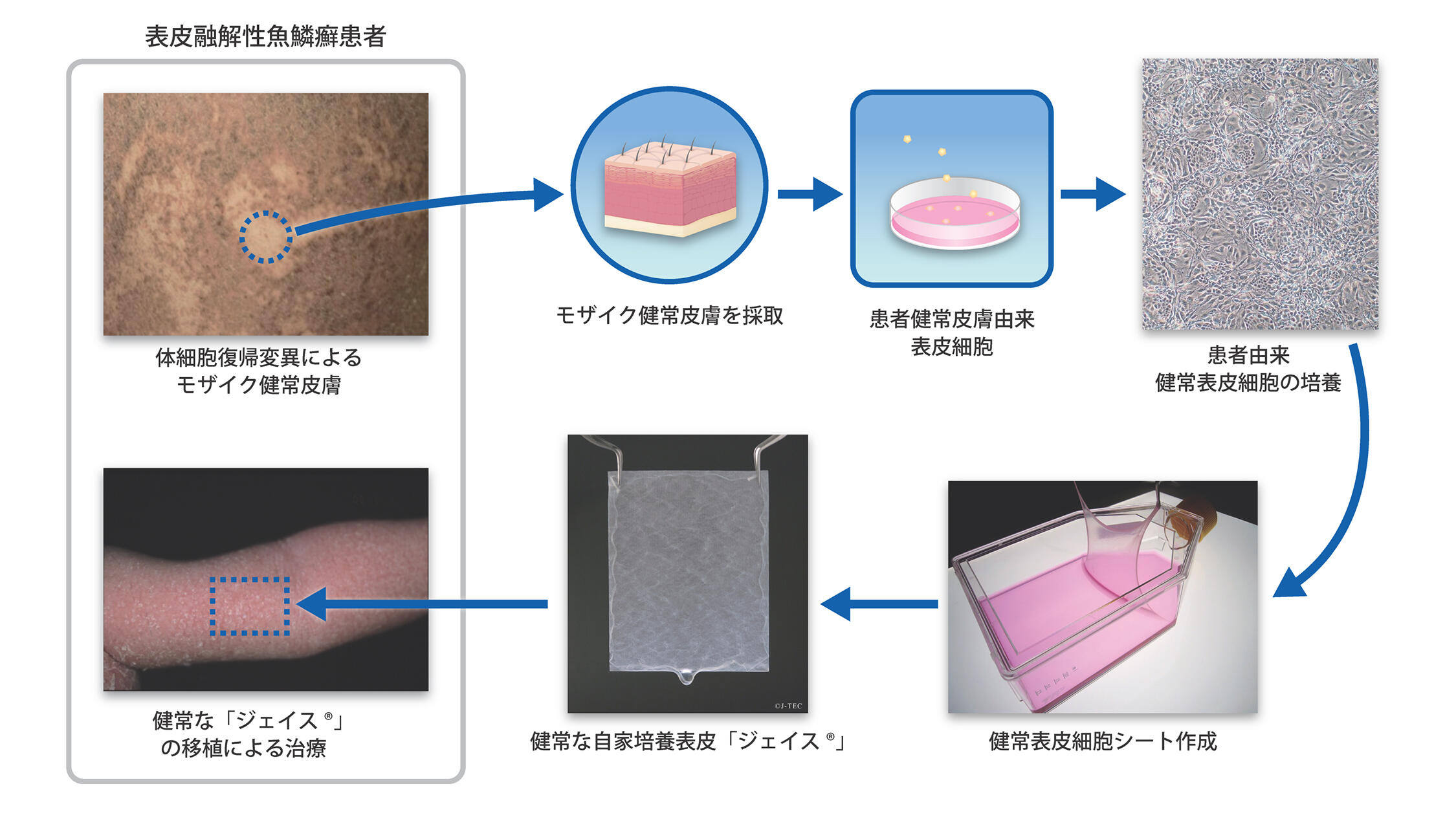 体細胞復帰変異によるモザイク健常皮膚由来の培養表皮シートを用