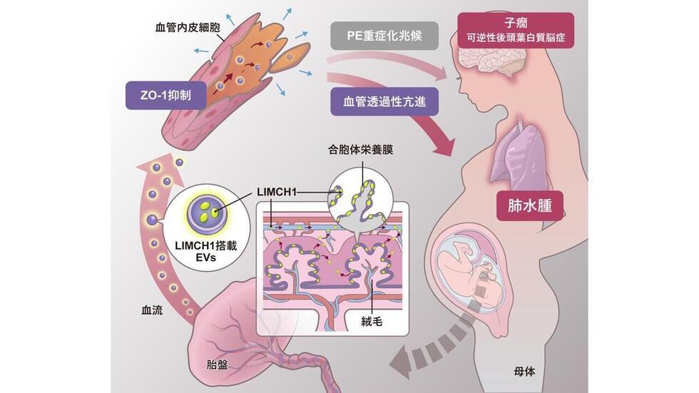早発型妊娠高血圧腎症の新たな病態メカニズムを解明～胎盤由来細胞外小胞による血管透過性亢進～