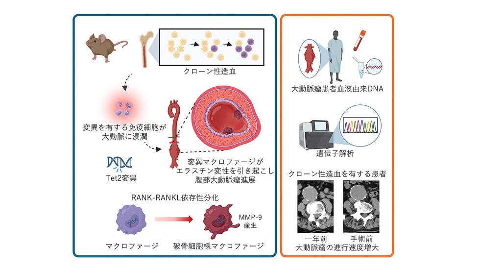 新たな視点：加齢に伴う血液の変化「クローン性造血」が大動脈瘤を悪化させる仕組みを解明～免疫細胞に着目した治療戦略の可能性～